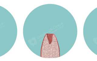 Диетотерапия при заболеваниях мышечной системы